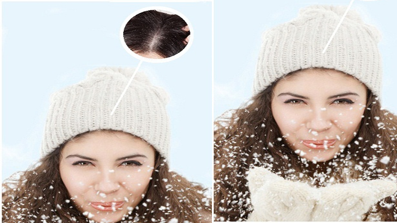 防止头皮屑在冬季